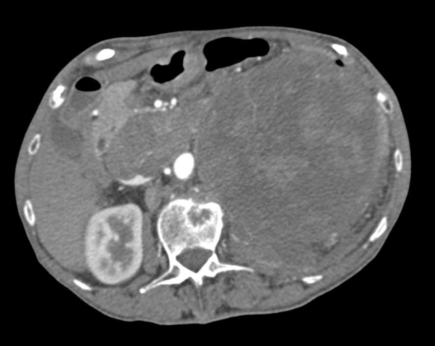 Renal Cell Carcinoma with Bleed and Vascular Invasion - CTisus CT Scan