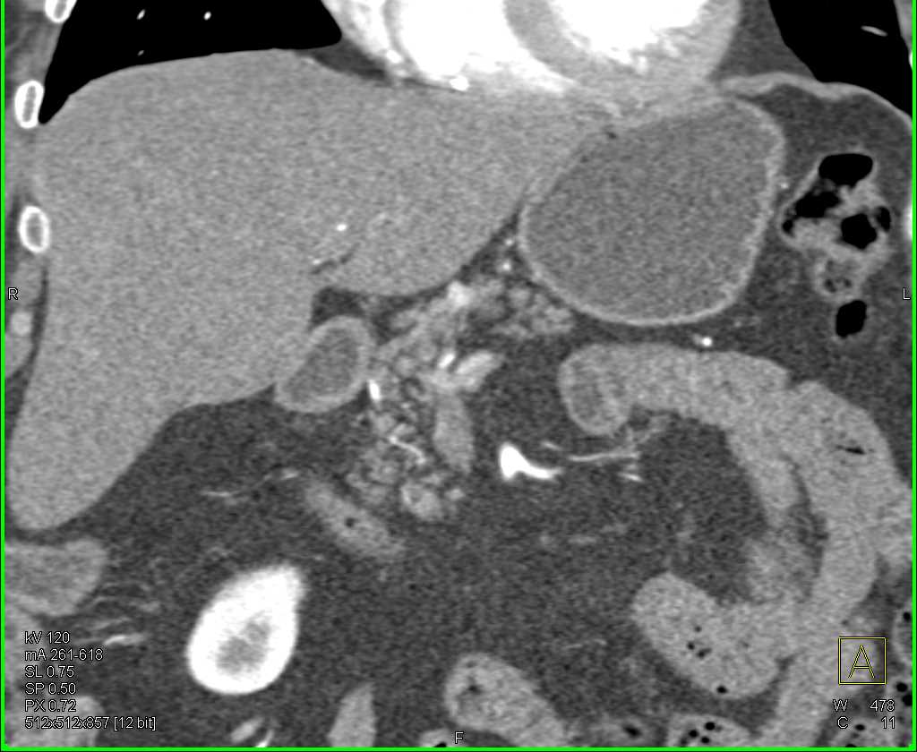 Metastatic Renal Cell Carcinoma to the Pancreatic Head - CTisus CT Scan