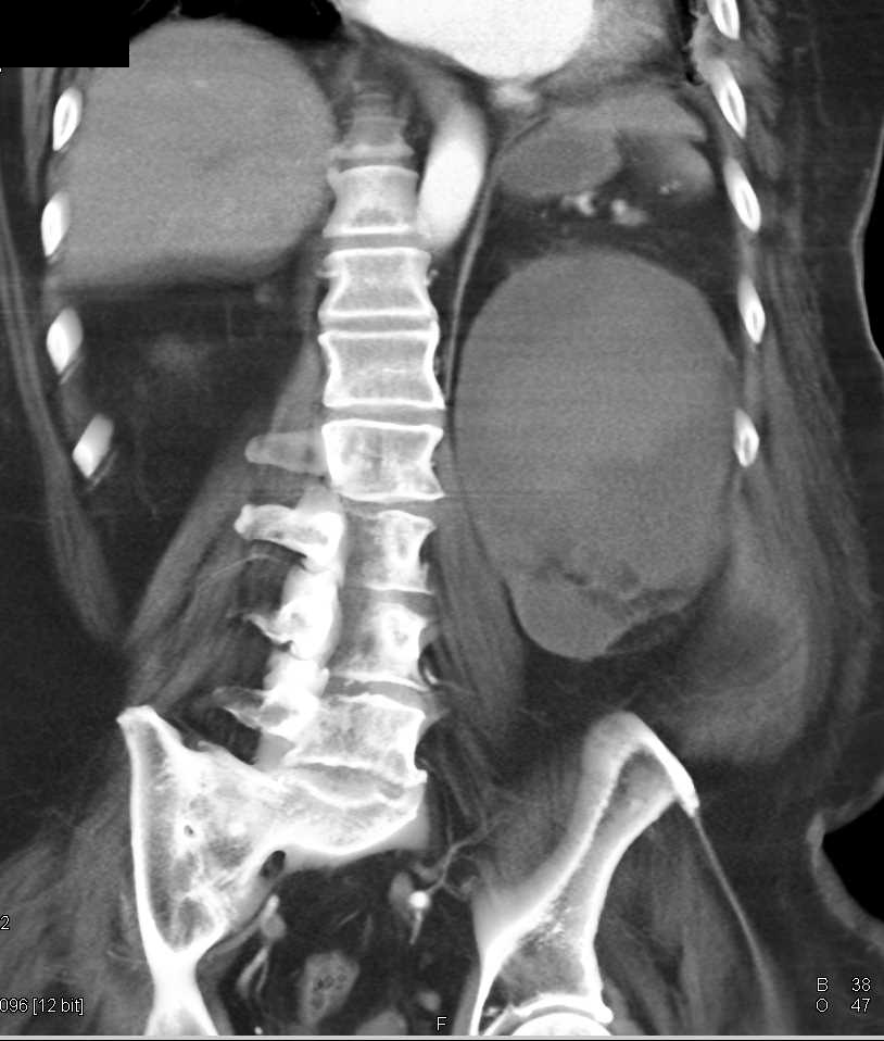 Cystic Left Renal Cell Carcinoma - CTisus CT Scan