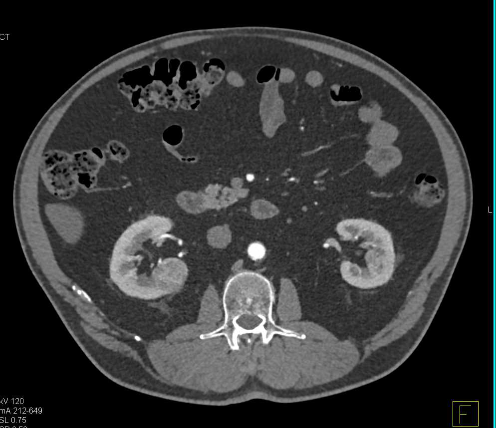 Papillary Renal Cell Carcinoma Right Kidney - CTisus CT Scan