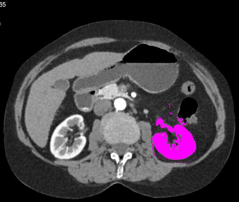 Volume Calculation of the Left Kidney - CTisus CT Scan