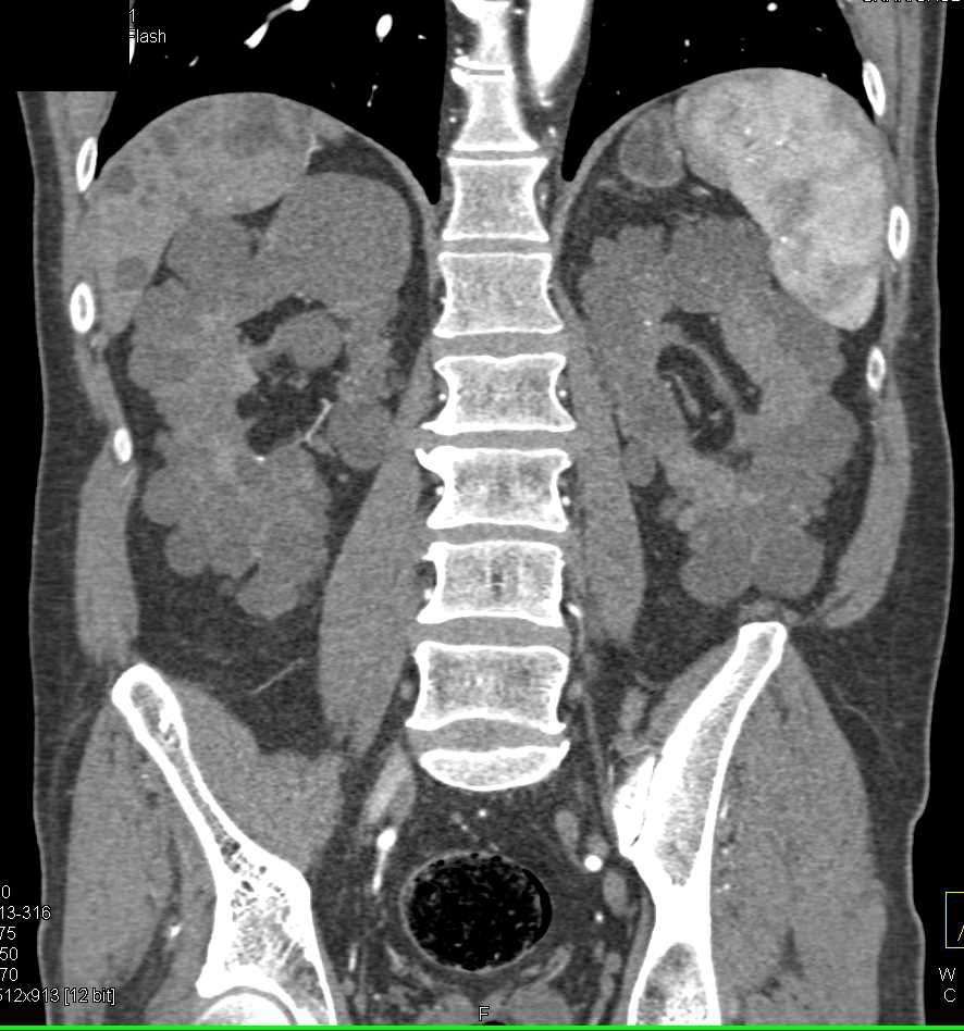 Transplant Kidney in a Patient with Polycystic Liver and Kidney Disease ...