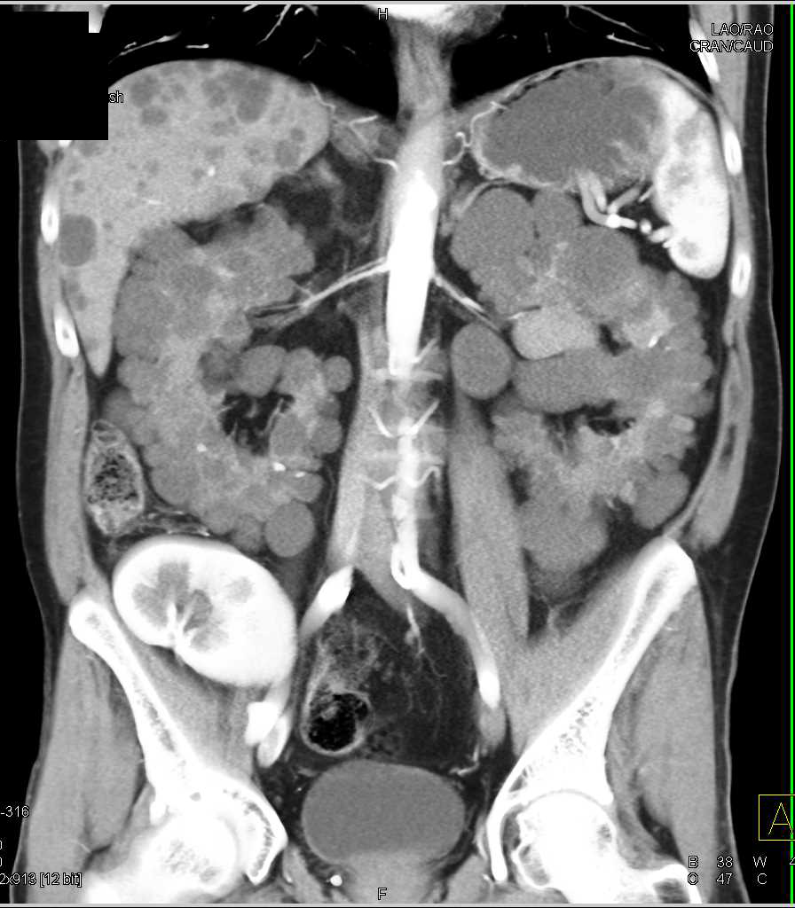 Transplant Kidney in a Patient with Polycystic Liver and Kidney Disease - CTisus CT Scan