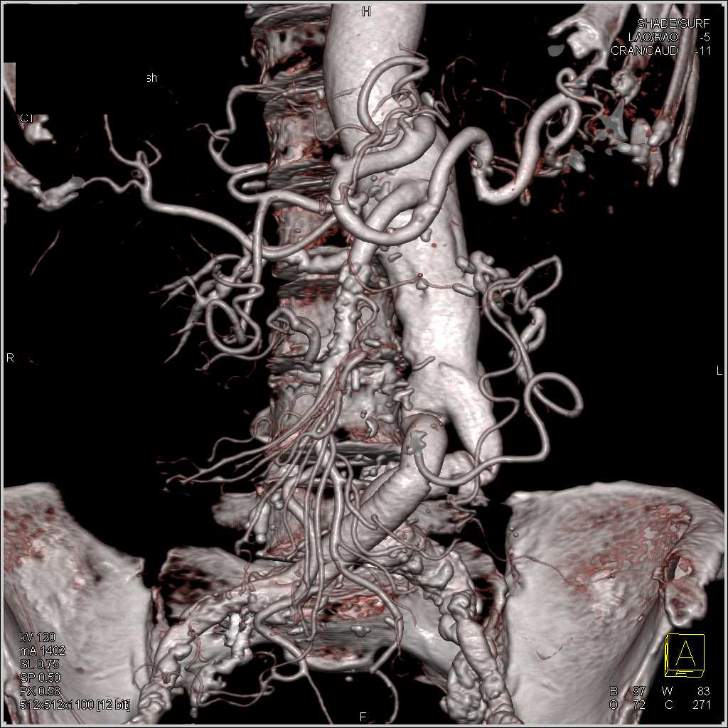 Aortic Aneurysm with Repair and Fibromuscular Dysplasia (FMD) Right Renal Artery - CTisus CT Scan