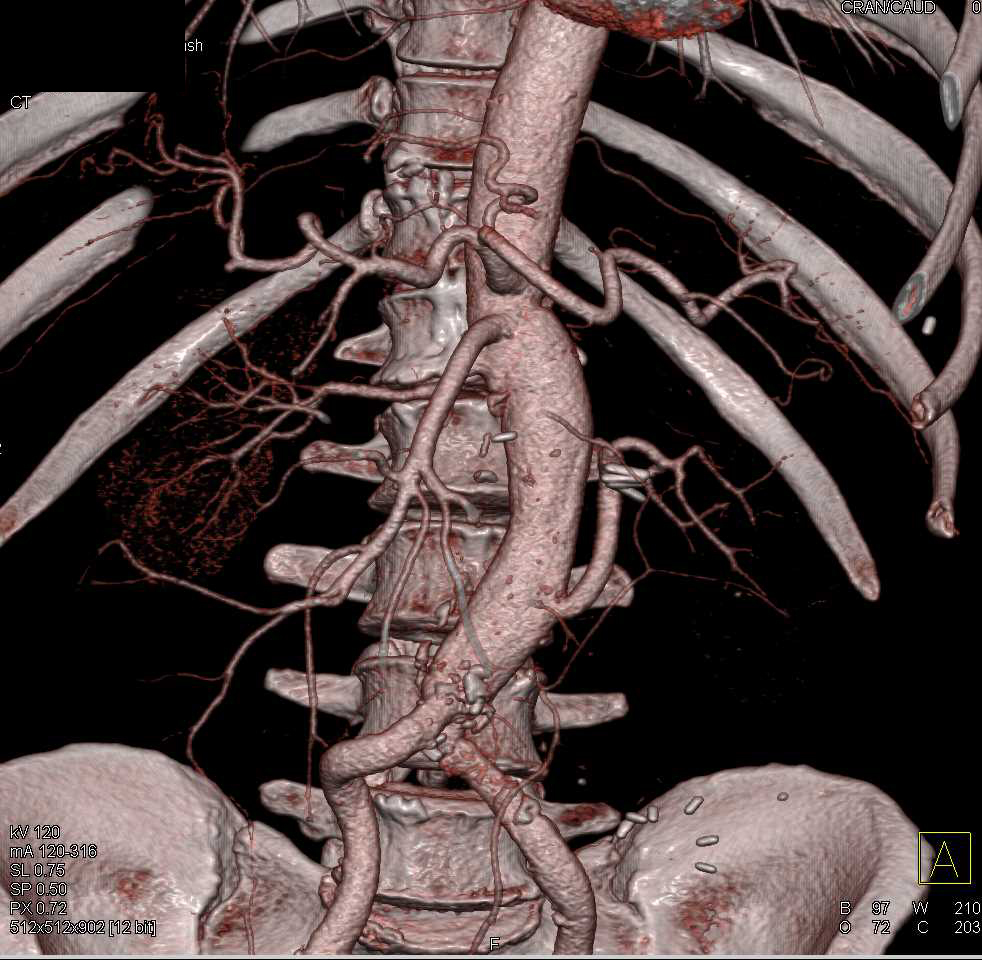 Reimplanted Left Renal Artery - CTisus CT Scan