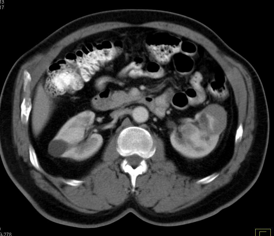 Cystic Left Renal Cell Carcinoma - CTisus CT Scan