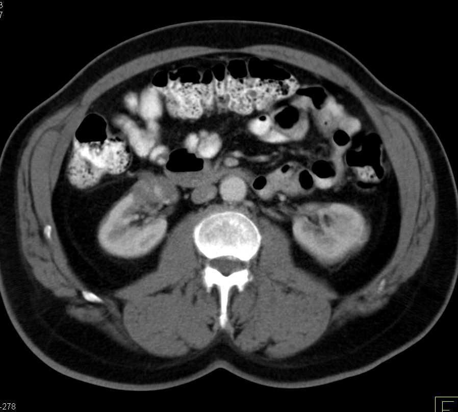 Cystic Left Renal Cell Carcinoma - Kidney Case Studies - CTisus CT Scanning