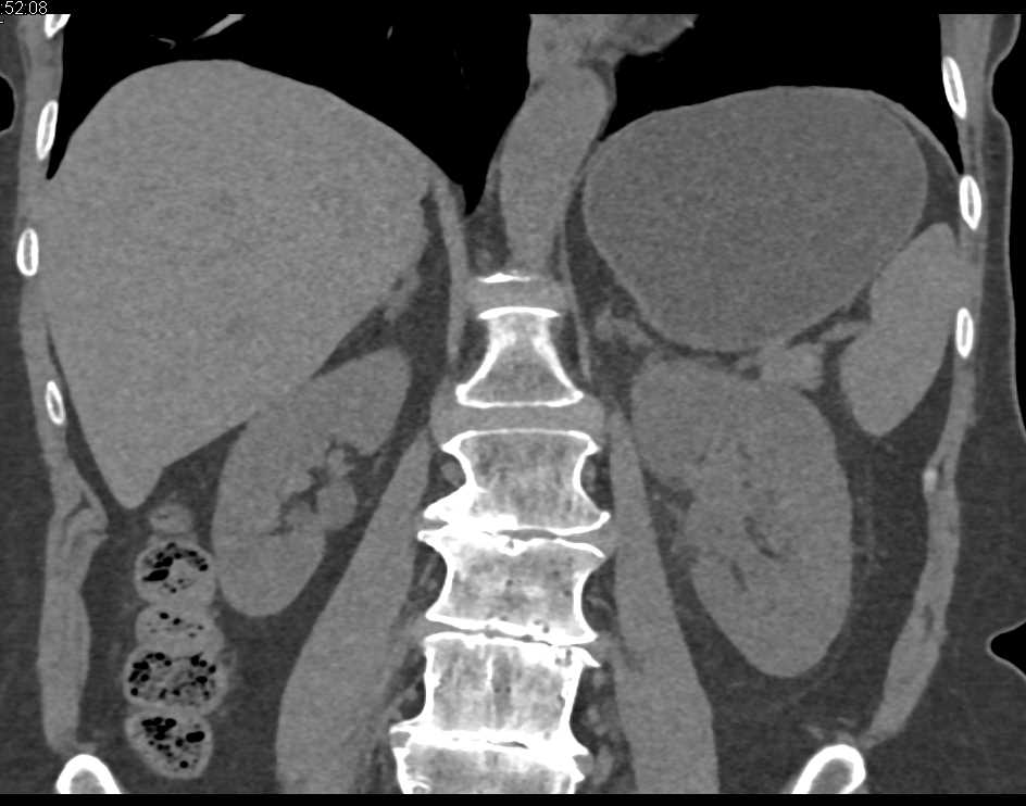 Multifocal Transitional Cell Carcinoma in Left Renal Pelvis and Bladder - CTisus CT Scan