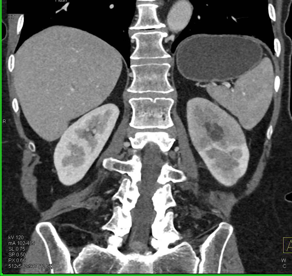 Multifocal Transitional Cell Carcinoma in Left Renal Pelvis - CTisus CT Scan