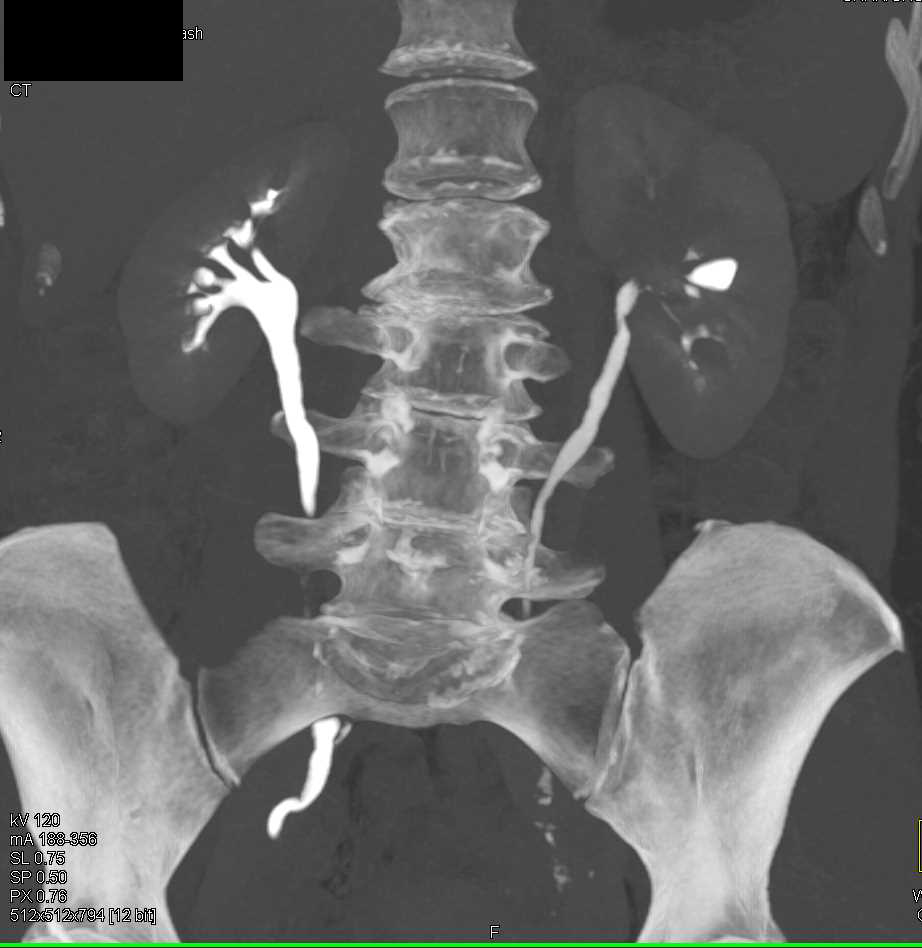 Multifocal Transitional Cell Carcinoma in Left Renal Pelvis and Bladder - CTisus CT Scan