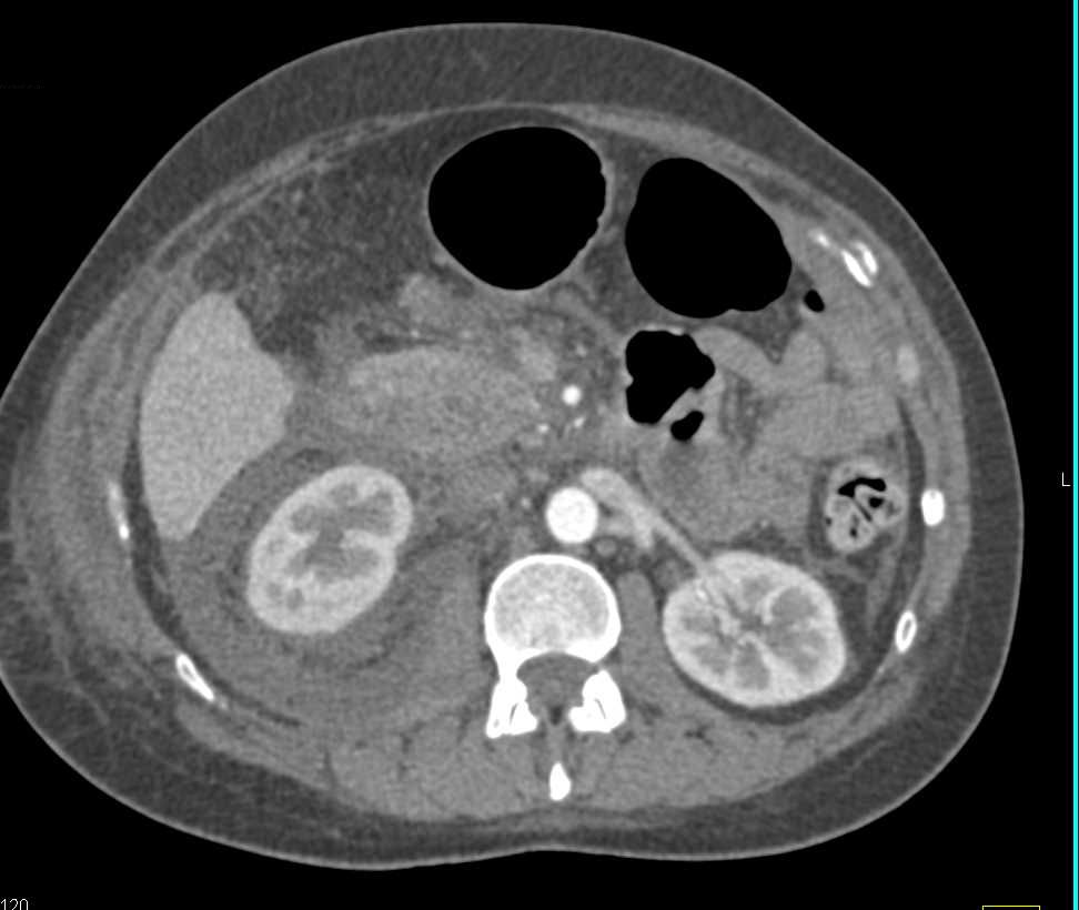 Post Endoscopic Retrograde Cholangiopancreatography (ERCP) Pancreatitis Involves the Right Peri and Pararenal Space - CTisus CT Scan