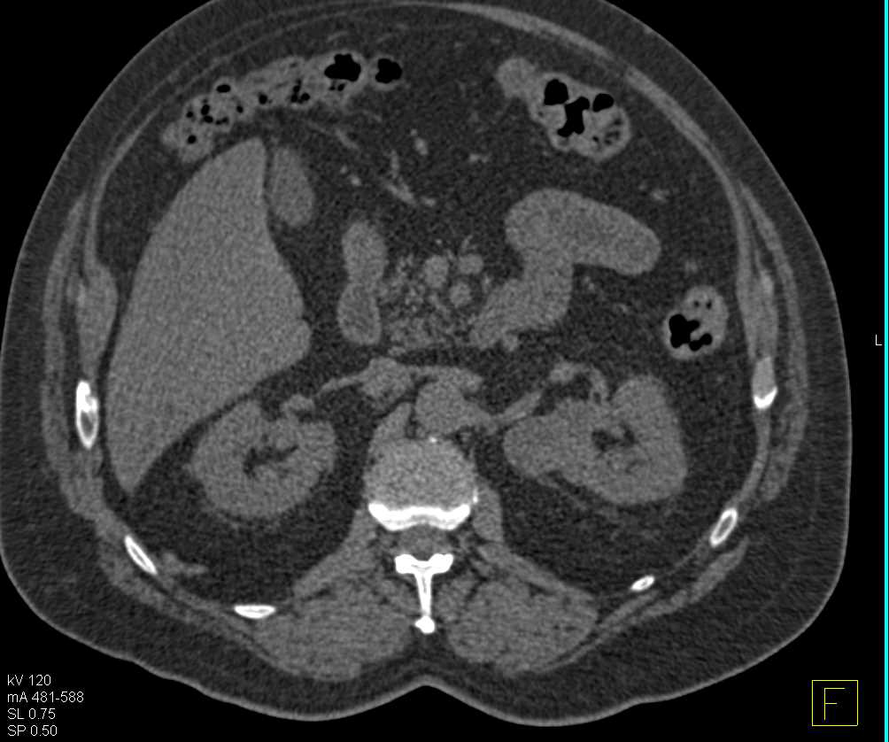 Left Papillary Renal Cell Carcinoma - CTisus CT Scan