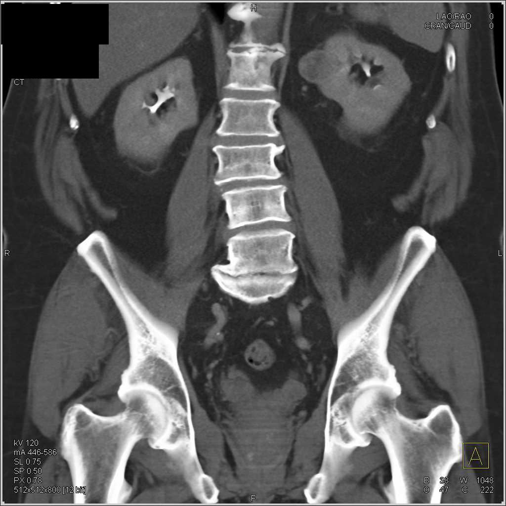 Papillary Renal Cell Carcinoma Left Kidney - CTisus CT Scan