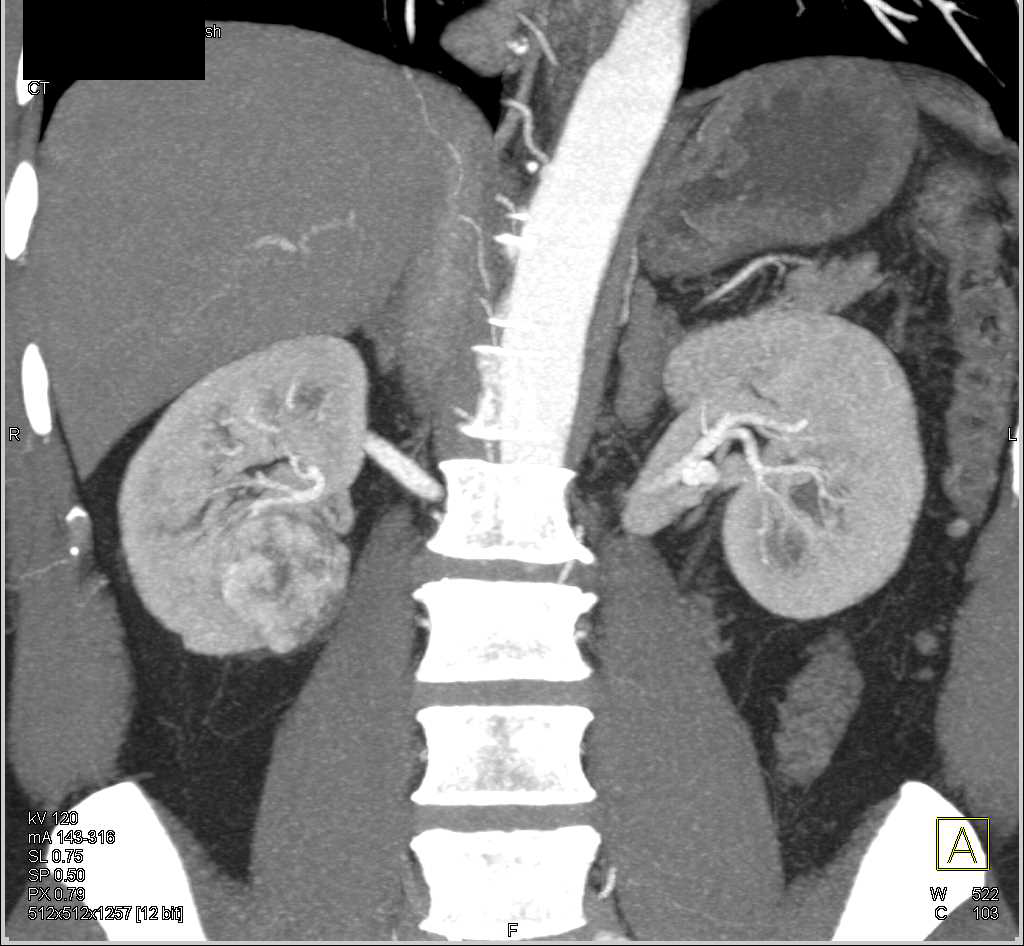 Clear Cell Renal Cell Carcinoma - CTisus CT Scan