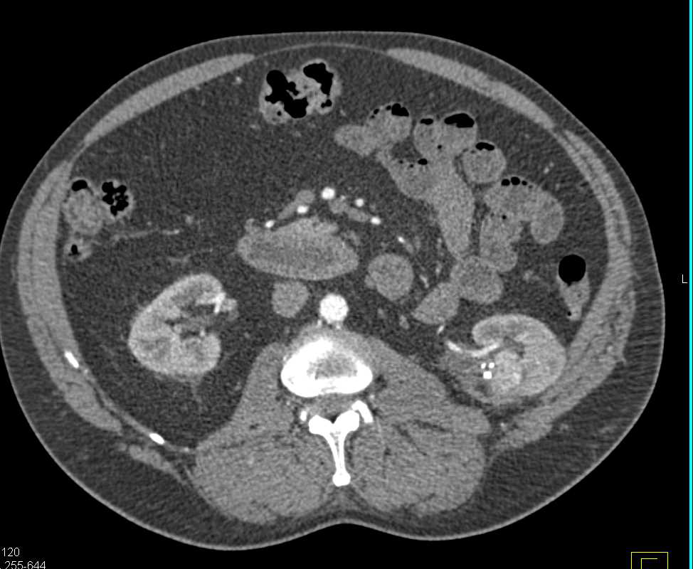 Recurrent Left Renal Cell Carcinoma at Ablation Site - CTisus CT Scan