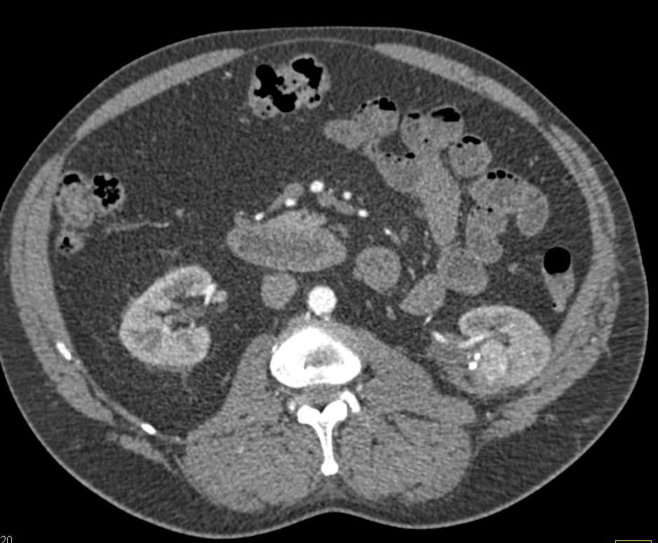 Recurrent Renal Cell Carcinoma Near Ablation  Site - CTisus CT Scan