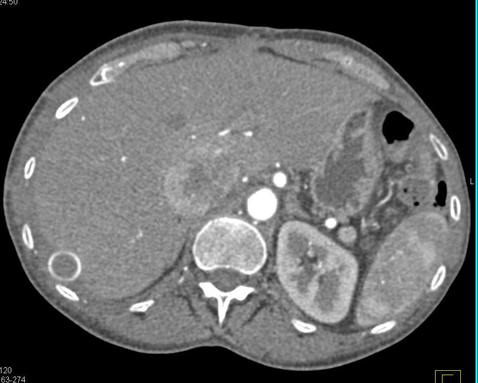 Renal Cell Carcinoma Invaded Inferior Vena Cava (IVC) and a Graft to Bypass the IVC was Created - CTisus CT Scan