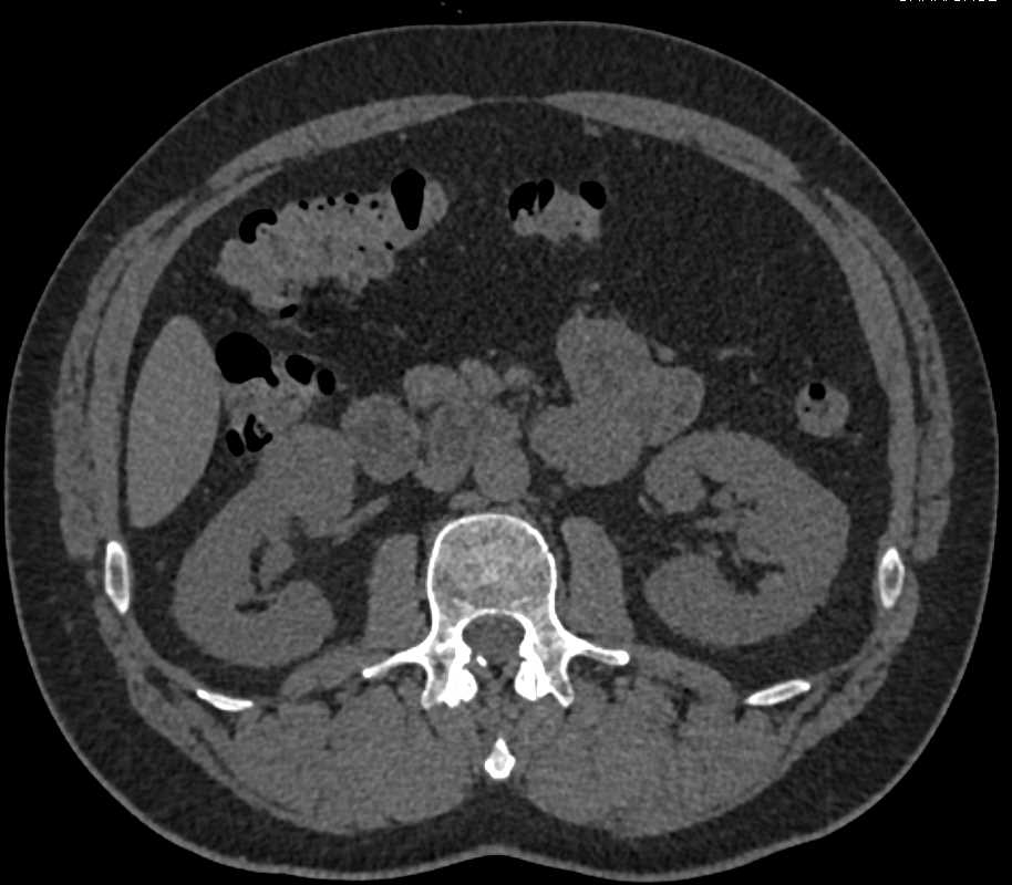 Papillary Right Renal Cell Carcinoma - CTisus CT Scan