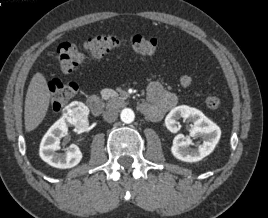 Papillary Right Renal Cell Carcinoma - CTisus CT Scan