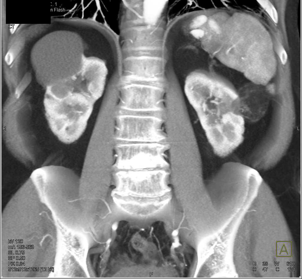 Angiomyolipoma Left Kidney - CTisus CT Scan