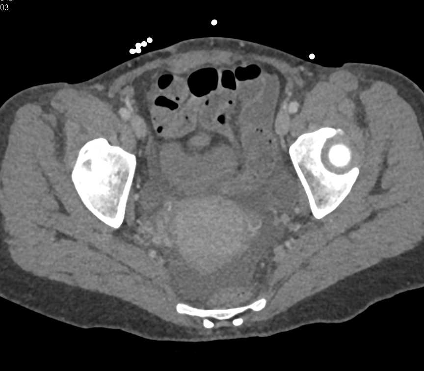 Acute Pyelonephritis Right Kidney - CTisus CT Scan