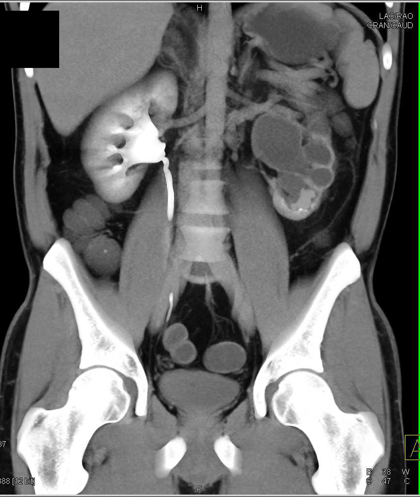 Obstructed Left Renal Pelvis with a Ureteropelvic Junction (UPJ) Obstruction - CTisus CT Scan