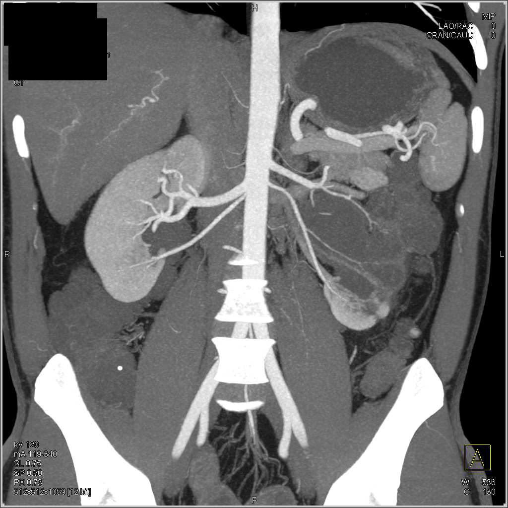 Left Ureteropelvic Junction (UPJ) with Crossing Accessory Left Renal ...