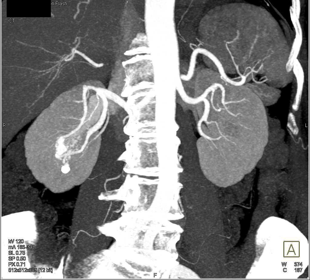 Arteriovenous Malformation (AVM) Near Right Renal Pelvis - CTisus CT Scan