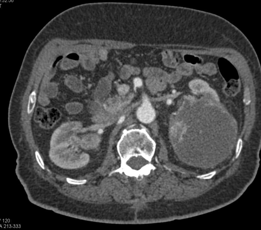 Cystic Left Renal Cell Carcinoma - CTisus CT Scan