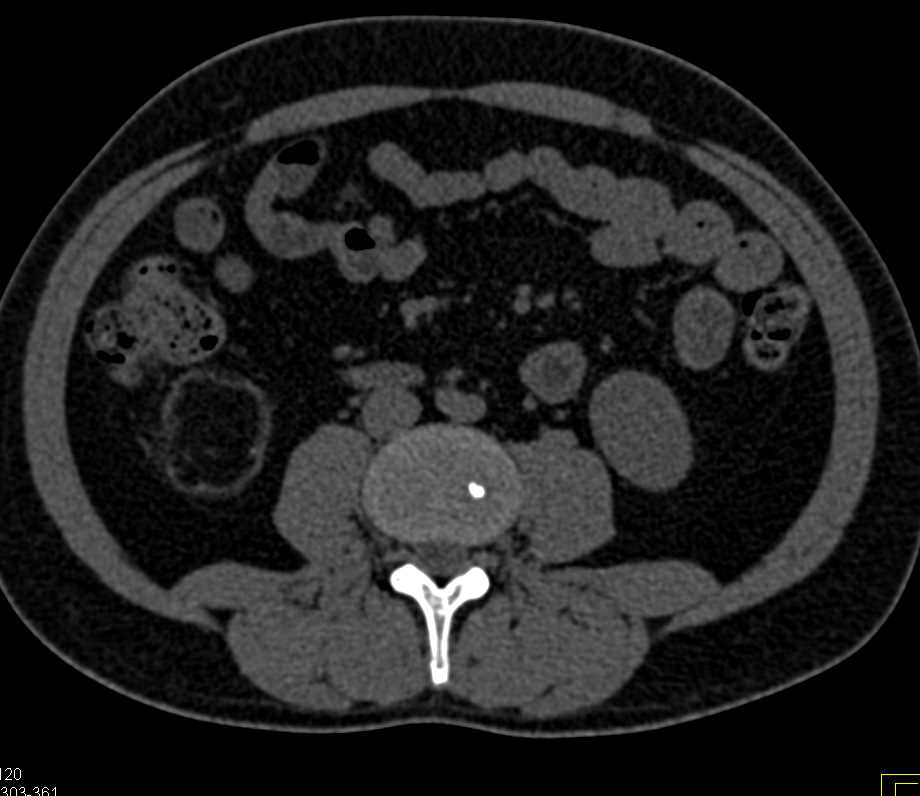 Post Radiofrequency Ablation (RFA) Changes Right Kidney - CTisus CT Scan