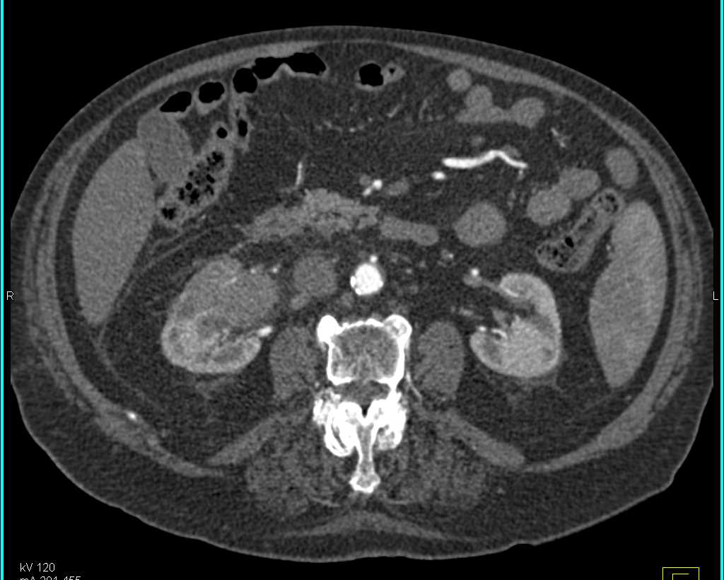 Transitional Cell Carcinoma Right Kidney - CTisus CT Scan