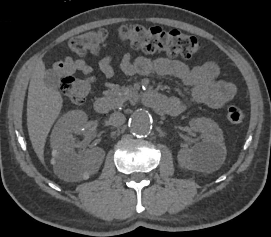 Multiple High Density Renal Cysts and Suspect Cystic Renal Cell Carcinoma - CTisus CT Scan