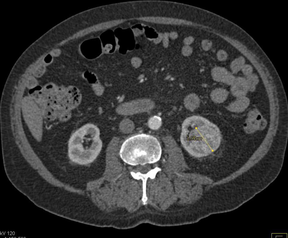 Bilateral Papillary Renal Cell Carcinoma - CTisus CT Scan