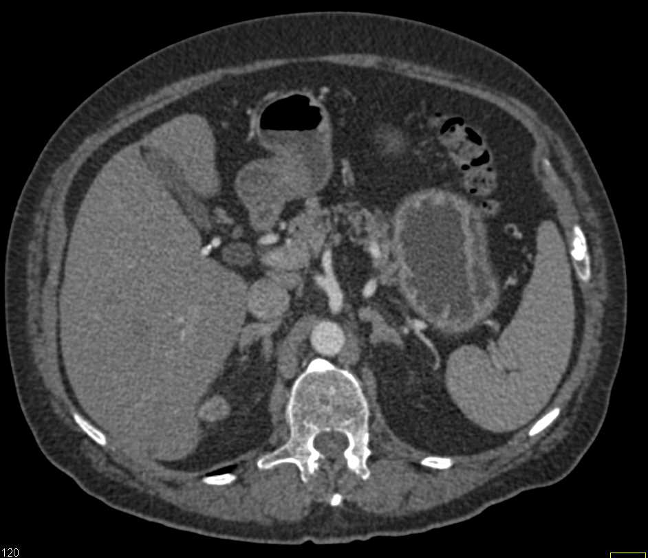 Left Papillary Renal Cell Carcinoma - CTisus CT Scan