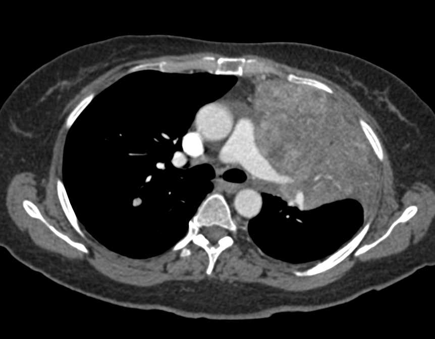 Renal Cell Carcinoma with Lung and Skin Lesions - CTisus CT Scan