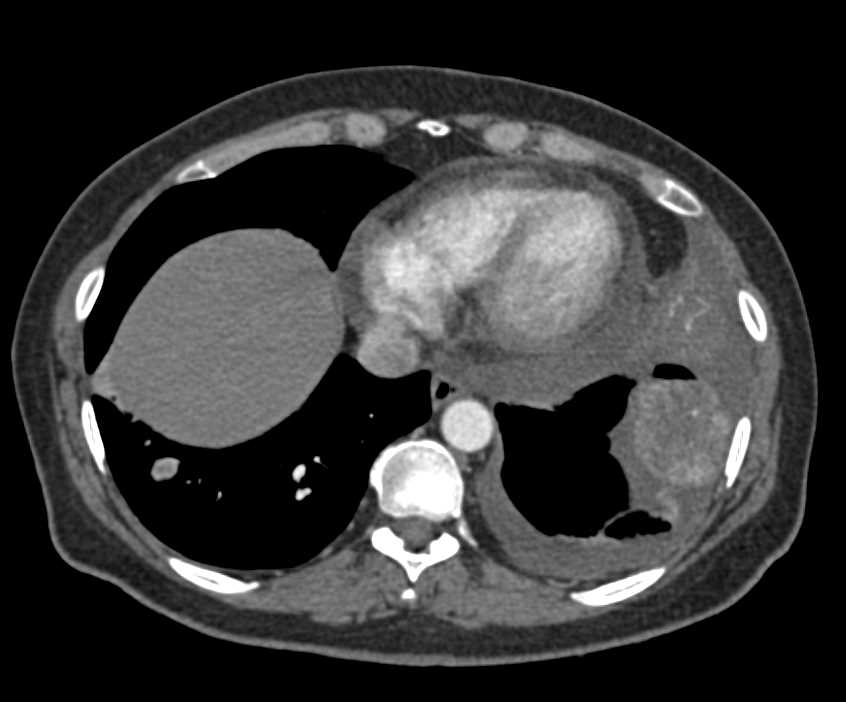 Renal Cell Carcinoma with Lung and Skin Lesions - CTisus CT Scan