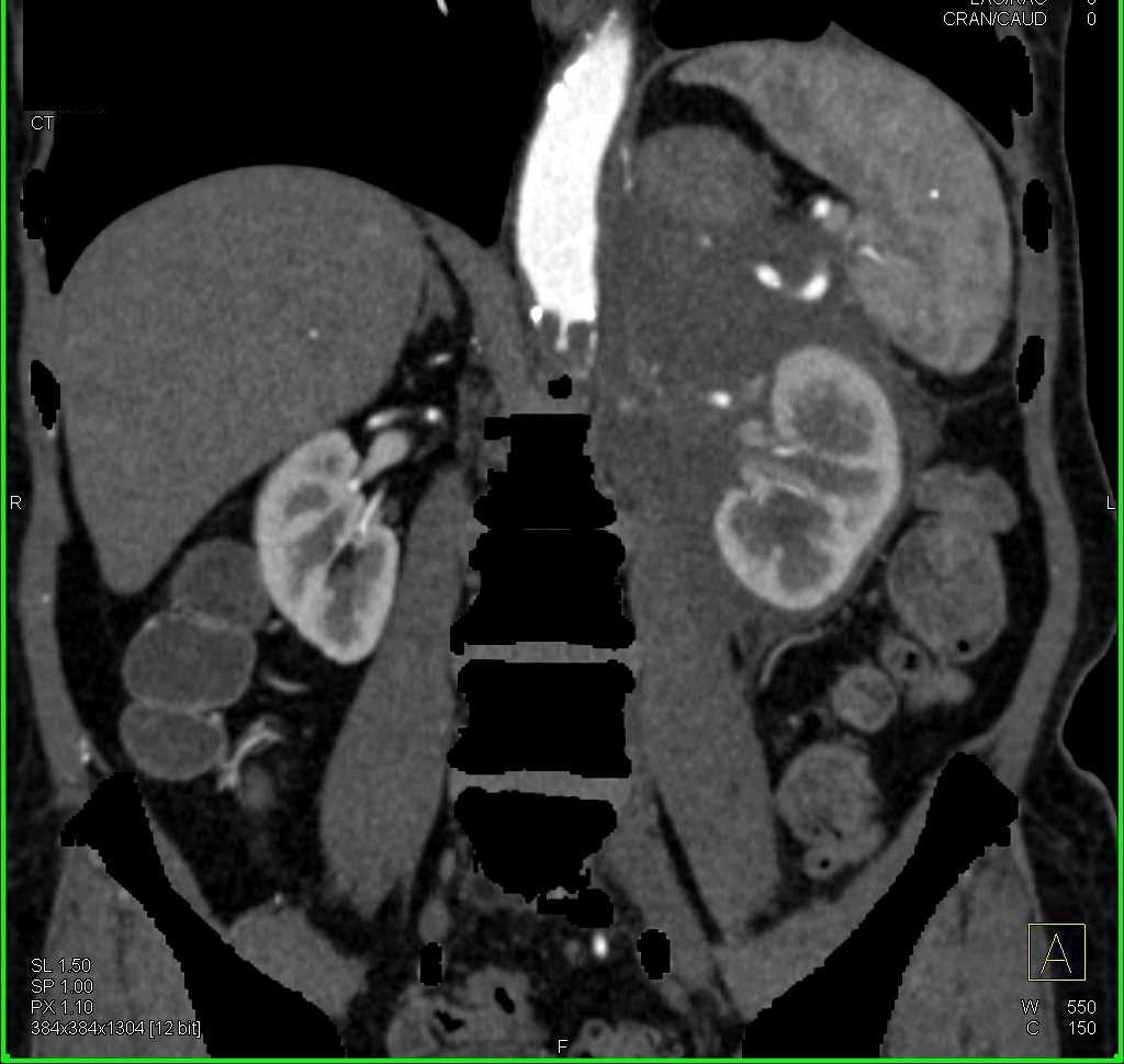 Lymphoma Infiltrates the Kidney and Perirenal Space - CTisus CT Scan