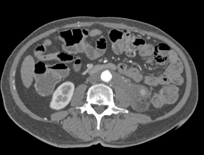 Lymphoma Infiltrates the Kidney and Perirenal Space - CTisus CT Scan