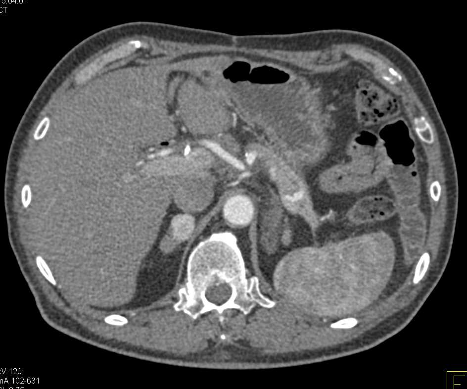 Vascular Metastases to the Pancreas and Right Adrenal Gland from Renal Carcinoma - CTisus CT Scan