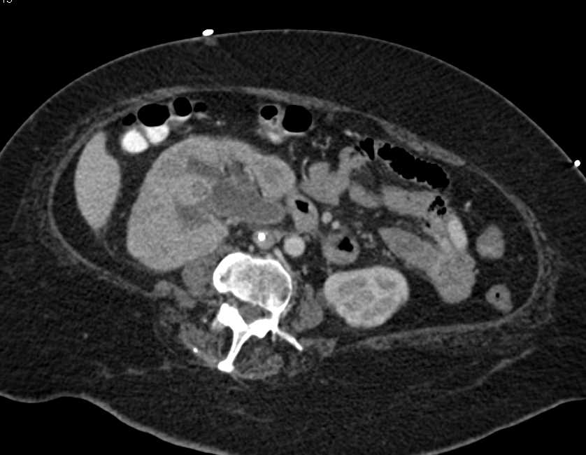 Right Hydronephrosis due to Stone in the Right Ureter - CTisus CT Scan