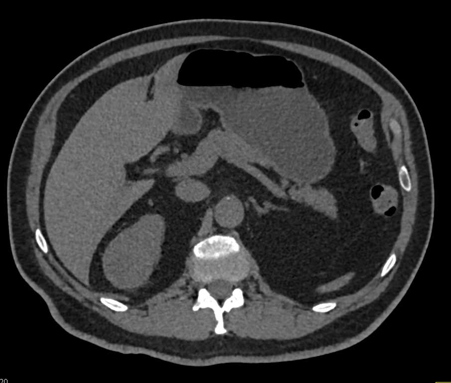 Papillary Renal Cell Carcinoma Right Kidney - CTisus CT Scan