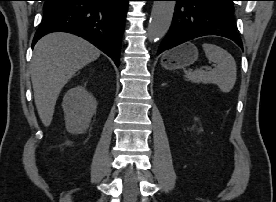 Papillary Renal Cell Carcinoma Right Kidney - CTisus CT Scan