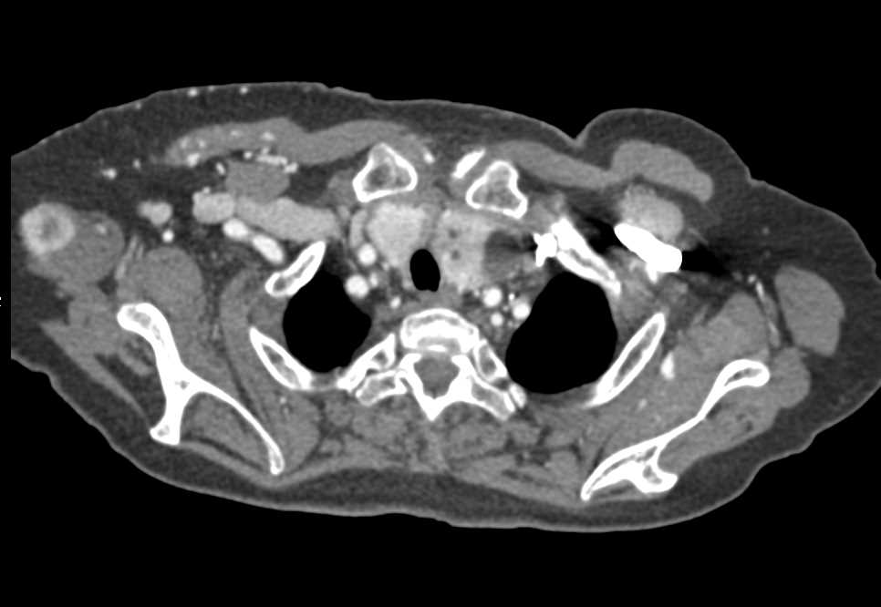 Metastatic Renal Cell Carcinoma to Muscle and the Pancreas - CTisus CT Scan