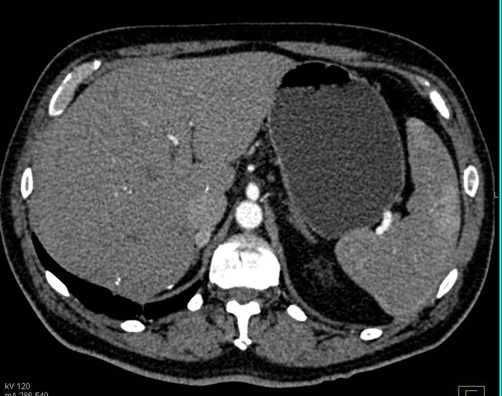 Recurrent Renal Cell Carcinoma with Adenopathy in the Chest and Abdomen as Well as Metastases to the Right Adrenal Gland - CTisus CT Scan