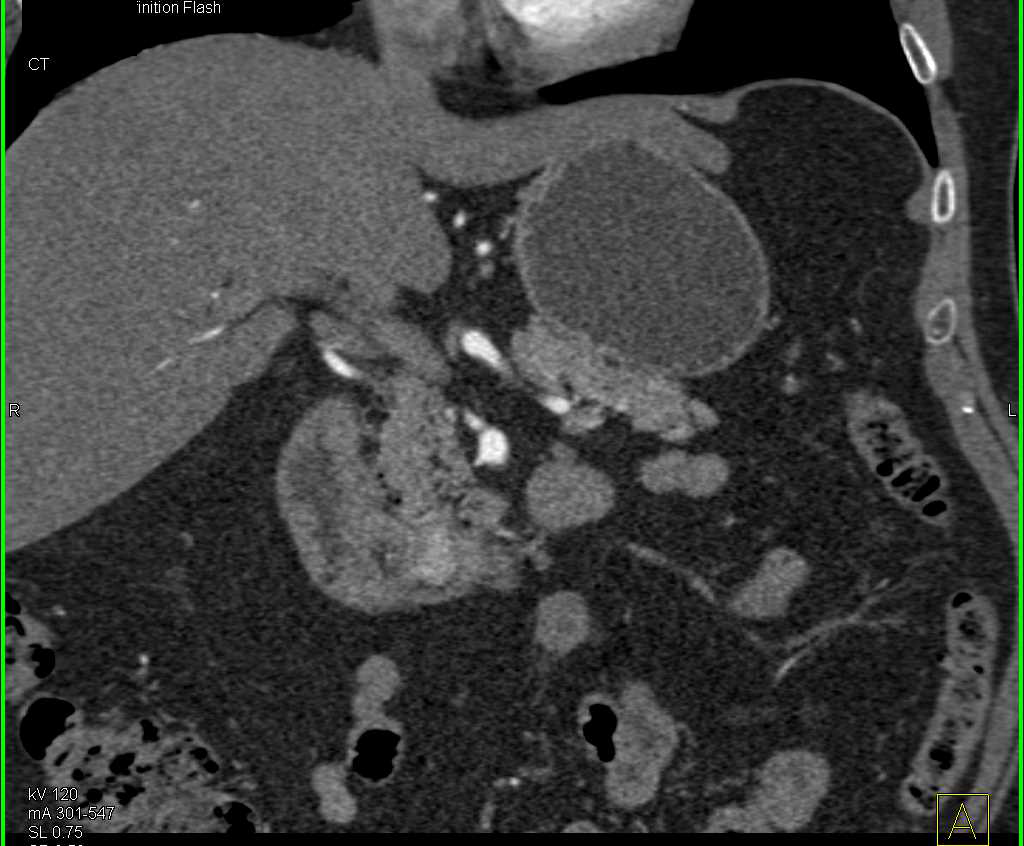 Subtle Vascular Metastases to Pancreas from Renal Cell Carcinoma - CTisus CT Scan