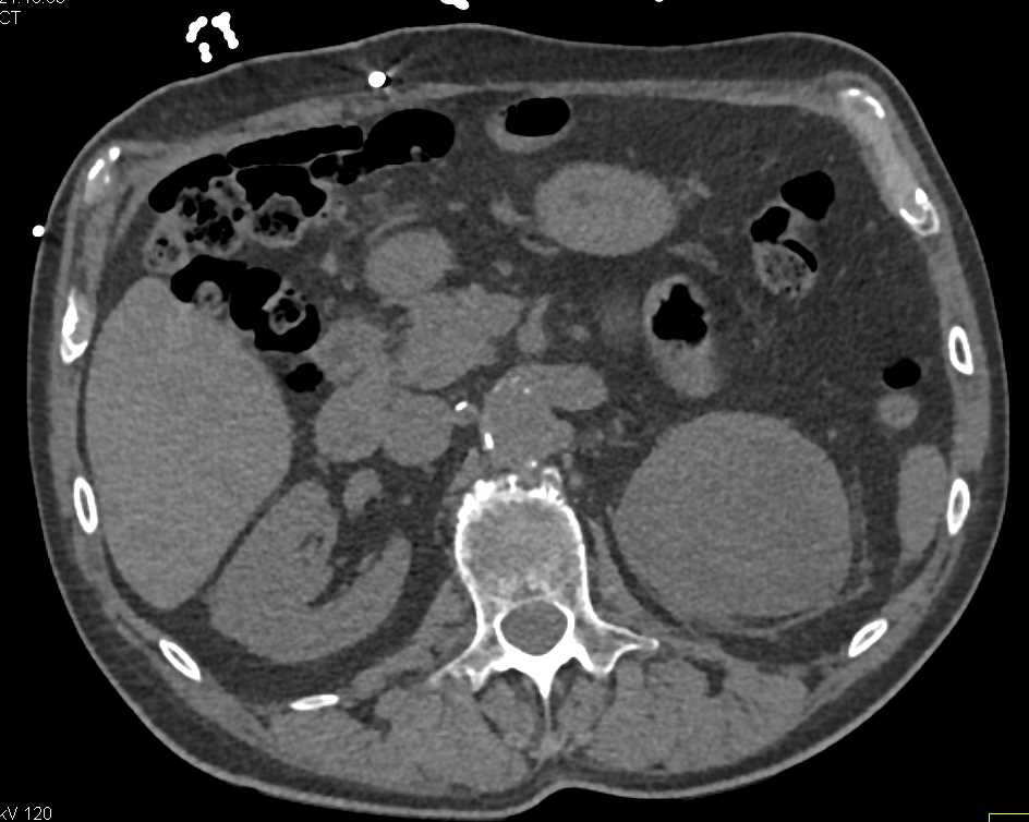 Papillary Renal Cell Carcinoma Left Kidney - CTisus CT Scan