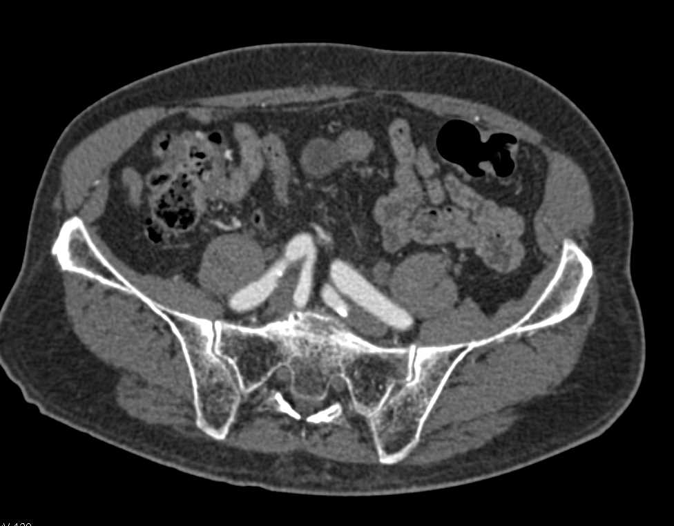 Transitional Cell Carcinoma Right Renal Pelvis - CTisus CT Scan