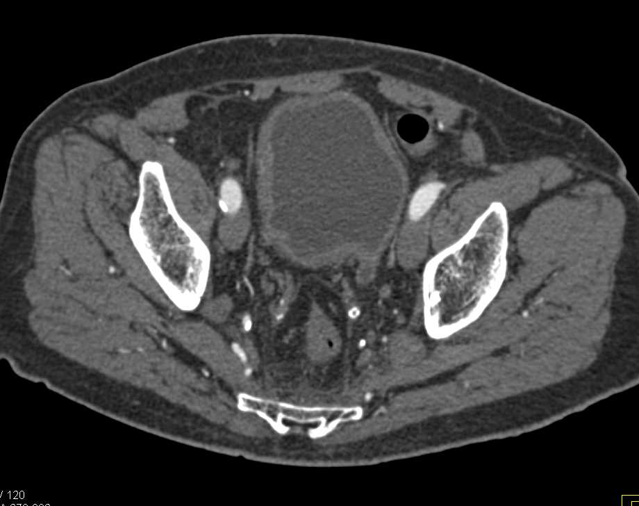 Transitional Cell Carcinoma Right Renal Pelvis - CTisus CT Scan