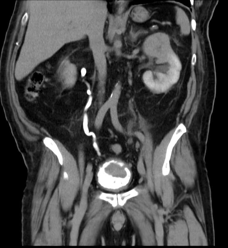 Left Renal Cell Carcinoma with Clot in Bladder - CTisus CT Scan