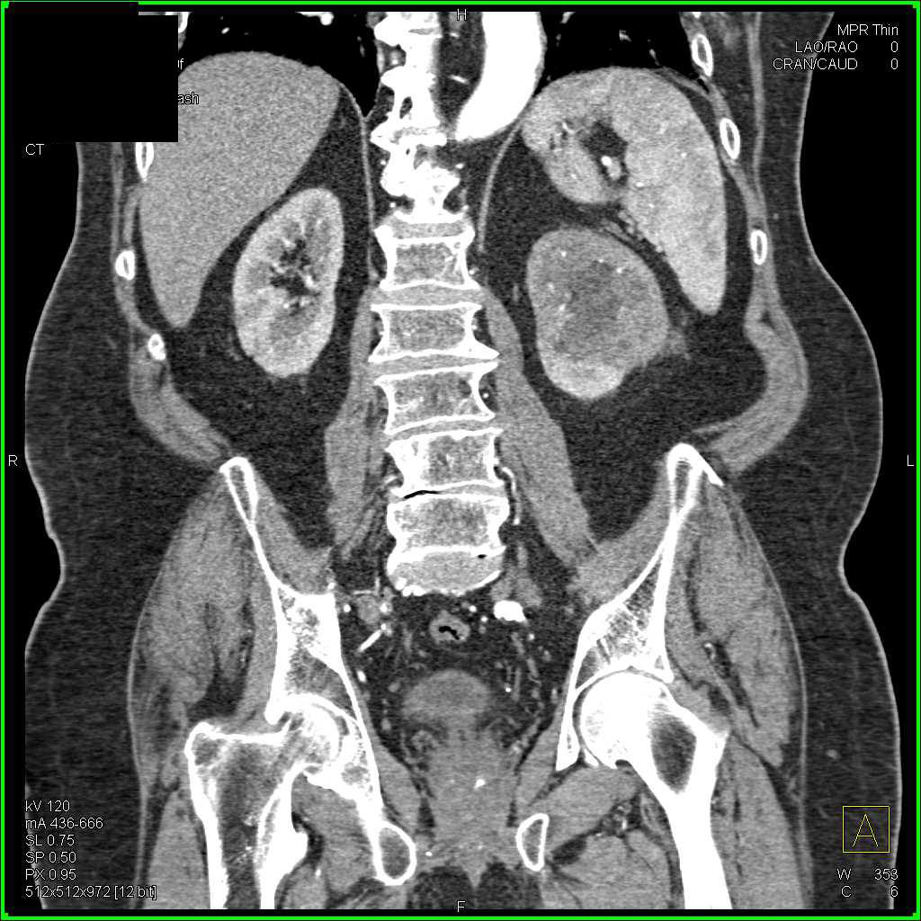 Transitional Cell Carcinoma Left Kidney - CTisus CT Scan